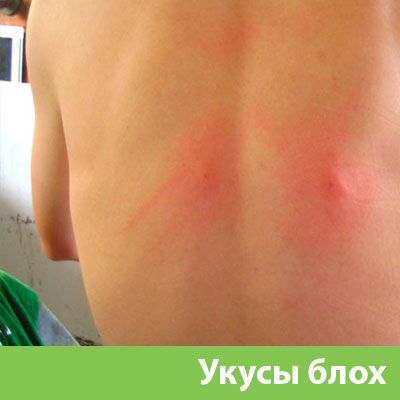 Укусы блох в Курске