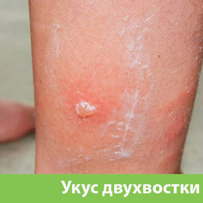 Укус двухвостки в Курске