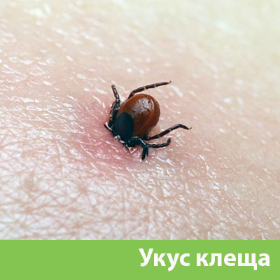 Укус клеща в Курске