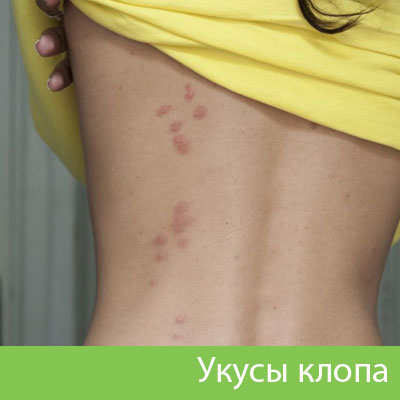 Профессиональное уничтожение клопов в Курске